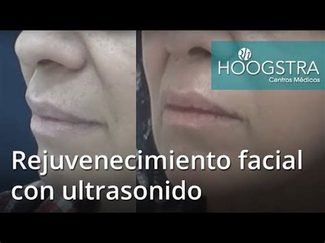 Rejuvenecimiento Facial Con Ultrasonido Youtube