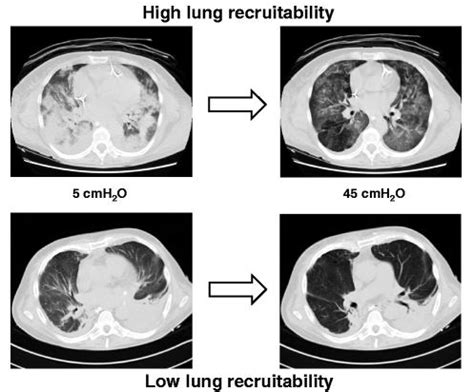 Optimal PEEP For Open Lung Ventilation In ARDS Deranged Physiology