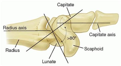 Reduction And Association Of The Scaphoid And The Lunate For