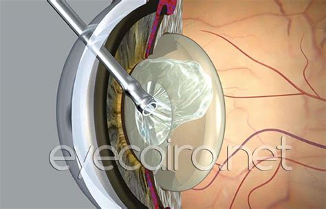 Procedures At Dr Khalil Eye Clinic Eye Of Cairo Dr Khalil Eye Clinic