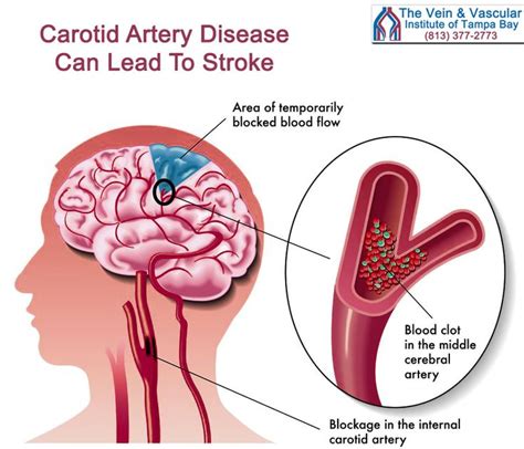 How Long Can You Live With Blocked Carotid Arteries Trang Toliver