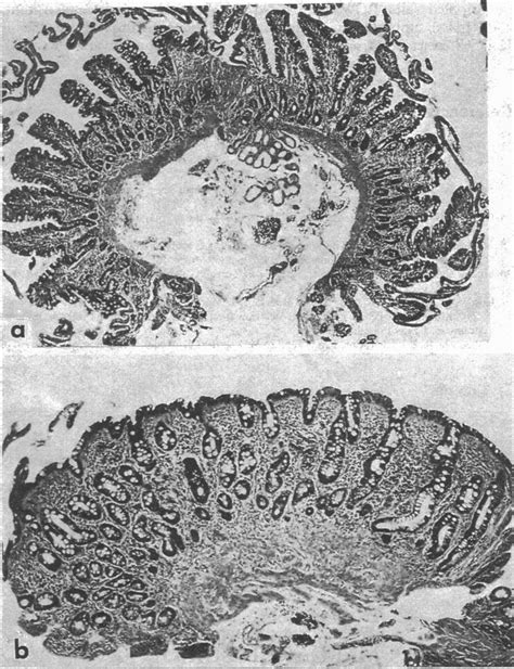 Adequate Duodenal Biopsy Specimens Obtained By Endoscopy Showing A