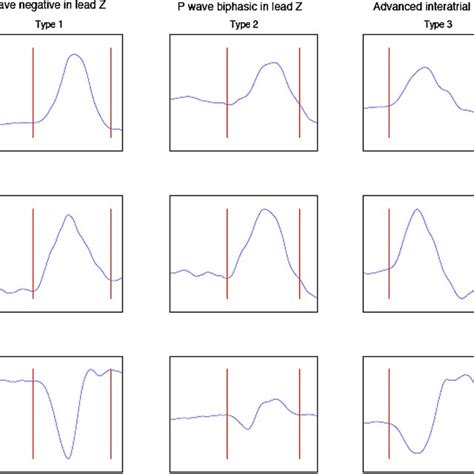 Schematic illustration of the P‐wave morphology classification. Type 1 ...