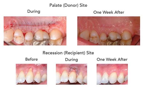 Gingival Graft Before And After