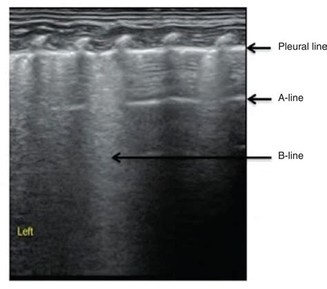 Interstitial Syndrome A Lung Ultrasound Demonstrated Interstitial Download Scientific Diagram