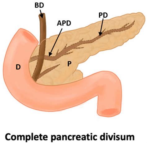 Pancreas Divisum Causes Symptoms Diagnosis Treatment And Prognosis