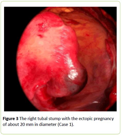 Ectopic Pregnancy Of The Tubal Stump In Art Patients Two Case Reports