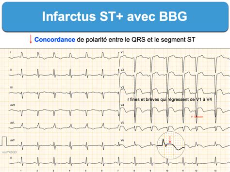 Infarctus Qrs Larges E Cardiogram