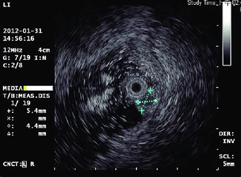 The Endoscopic Ultrasonography Showed A Hypoechoic Homogeneous Nodule Download Scientific