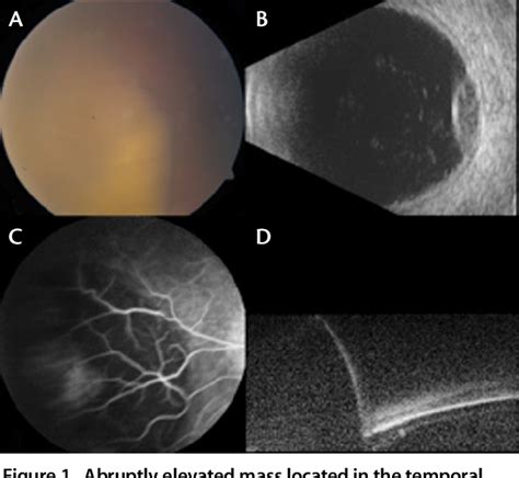 Figure 1 From Peripheral Exudative Hemorrhagic Chorioretinopathy