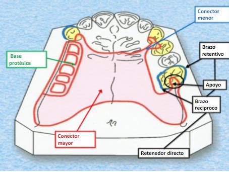 COMPONENTES DE UNA PROTESIS PARCIAL REMOVIBLE COMPONENTES DE UNA