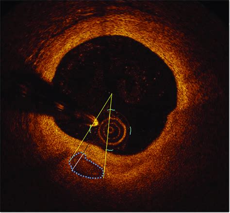 Morphological Analysis Of Calcification Using Optical Coherence Download Scientific Diagram