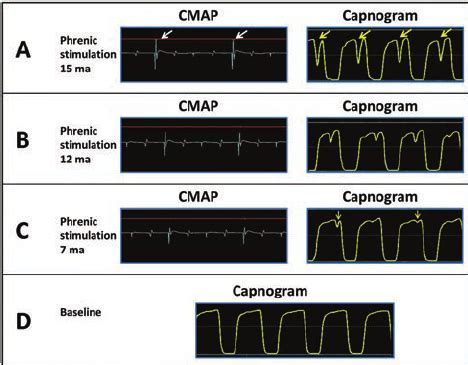 Pre Ablation Assessment Of Phrenic Nerve Stimulation Correspondence