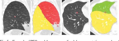 Figure From Automatic Segmentation Of Pulmonary Segments From