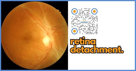 Retinal Detachment A Comprehensive Patient Guide Roque Eye Clinic