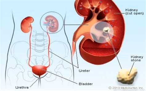 7 Tips Mencegah Batu Ginjal