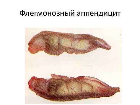 Острый аппендицит Appendicitis acuta Классификация