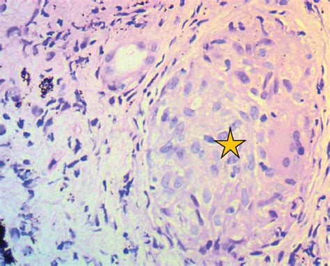 A B H E 100 Shows Effacement Of Lung Tissue By Multiple Variably