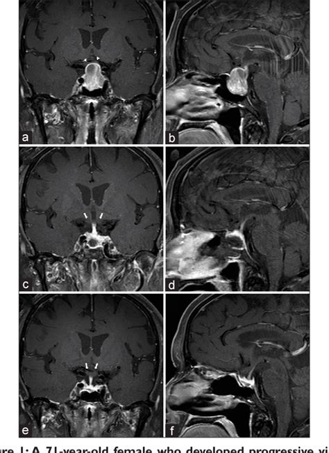 Figure From The Expanding Role Of The Endonasal Endoscopic Approach