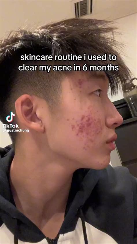 How I Faded Acne Scars Artofit