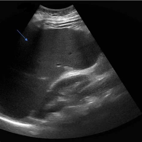 Abdominal ultrasound showing splenomegaly (arrowhead) | Download Scientific Diagram