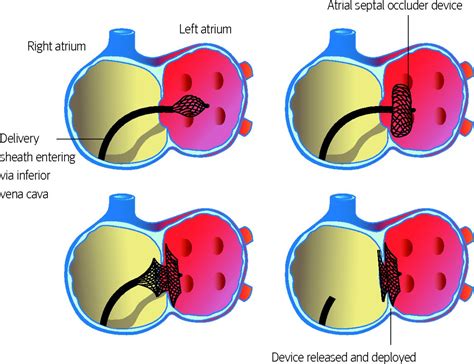 Congenital Heart Disease In Adults The Bmj