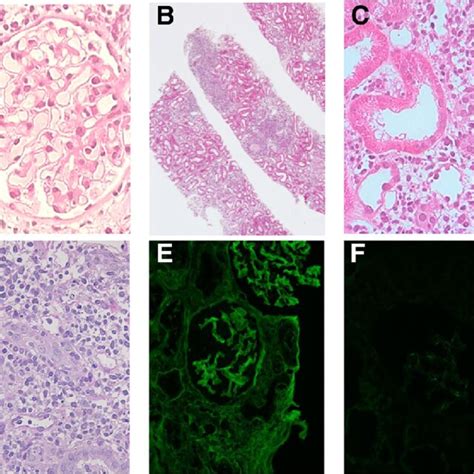 Figure The Renal Biopsy Findings In Case A Light Microscopy Of The