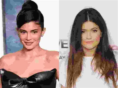 Setting The Record Straight Kylie Jenner Addresses Facial Surgery