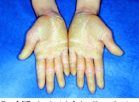 Figure 1 From Epidermolytic Palmoplantar Keratoderma Vorner S