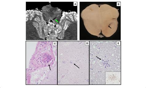 Ex Vivo Mri And Autopsy Neuropathology In Case A Ex Vivo Axial T