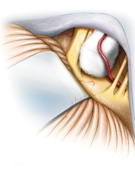 Hemifacial Treatment Surgery For Hemifacial Seattle Neuroscience