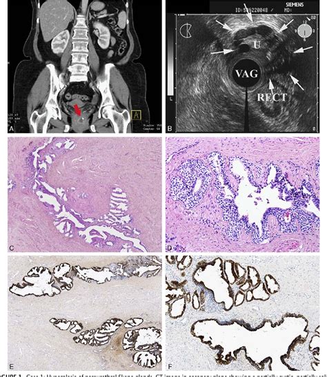 Prostatic Type Tissue In The Lower Female Genital Tract A Morphologic