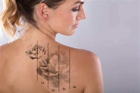 Revlite Si Laser Tattoo Removal Ageless Beauty Laser Spa Surrey Bc