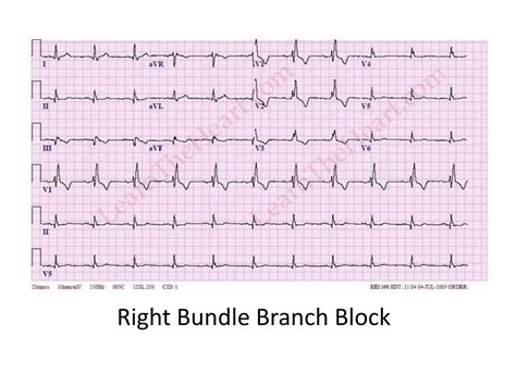 Ppt Ecg Powerpoint Presentation Free Download Id9283108