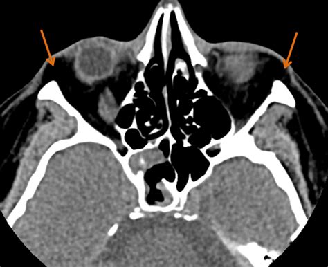 August 25 2014 Case Of The Week American Journal Of Neuroradiology