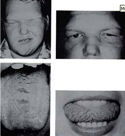 Ocular Pathology What Is Melkersson Rosenthal Syndrome