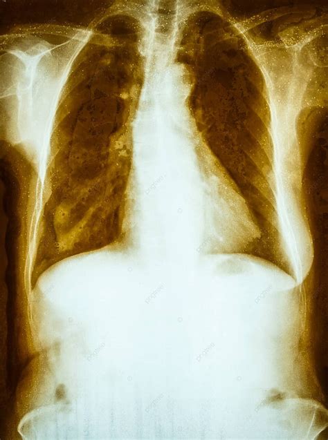 Fundo Radiografia De Tórax Adulto Aparência De Filme Envelhecido E