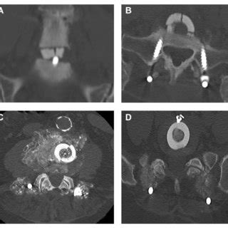 Computed tomography scan examples of patients with femoral ring ...