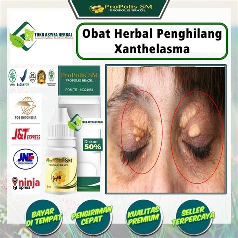 Jual Obat Penghilang Xanthelasma Gumpalan Lemak Di Kelopak Mata Karena