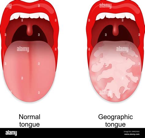 Geographic Tongue Benign Migratory Glossitis Oral Cavity Anomalies