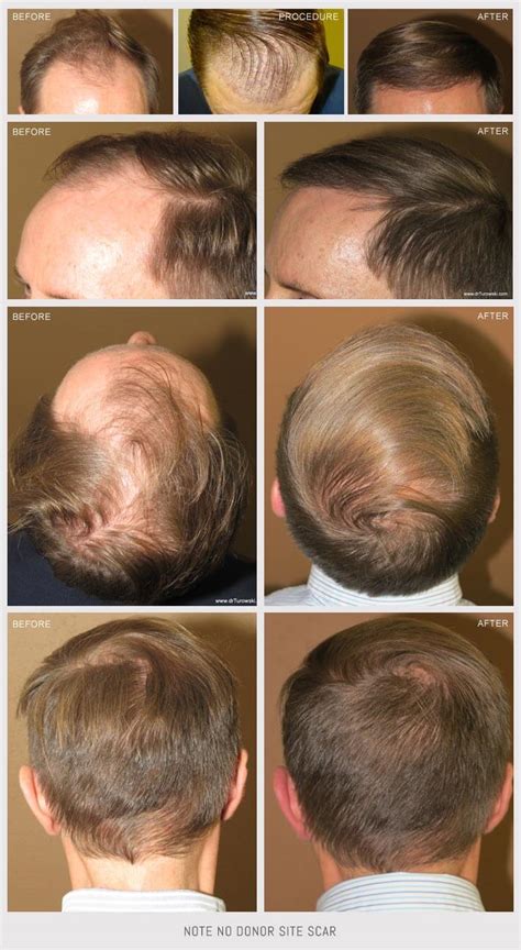 Before and After Picutres | ARTAS – Trasplante Robotizado de Pelo