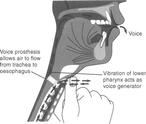 Potd Tracheostomy And Laryngectomy Emergencies — Maimonides Emergency