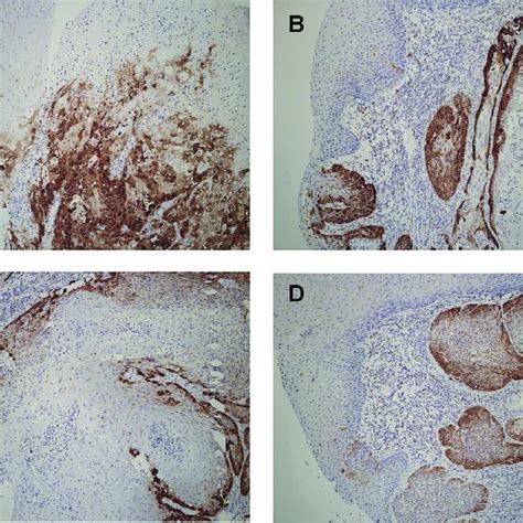 Expression Of P16 In Oropharyngeal Cancer Cells Immunohistochemistry Download Scientific