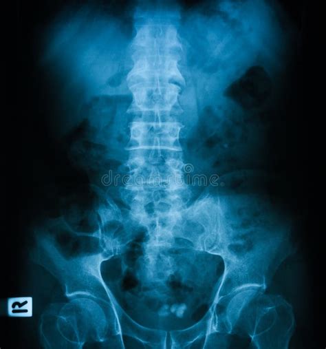 X Ray Image Of Plain Kub Stock Image Image Of Inflammation 54283489