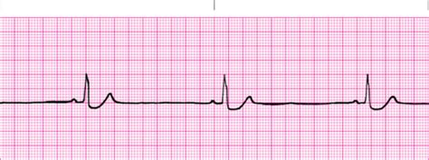 Ekg Strips Flashcards Quizlet