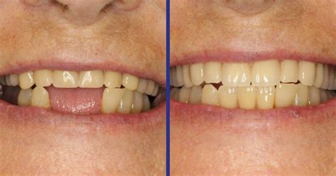 The Amazing Impact Of Dentures Real Before After Pictures