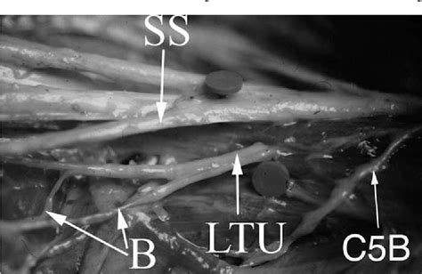 Figure 1 from Long thoracic nerve: anatomy and functional assessment ...