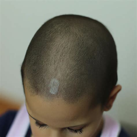 Descubra o que é a Alopecia Androgenética e Saiba Como Tratá la