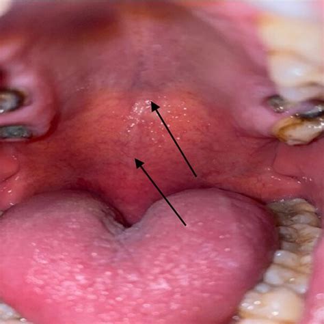 The Oropharyngeal Mass Pushing Back The Soft Palate And Uvula