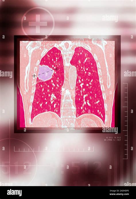 Lung Cancer Coloured Computed Tomography Ct Scan Of A Patient With Lung Cancer A Malignant